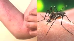 Dünya Chikungunya Salgını Tehlikesiyle Yüz Yüze: Türkiye Risk Altında!