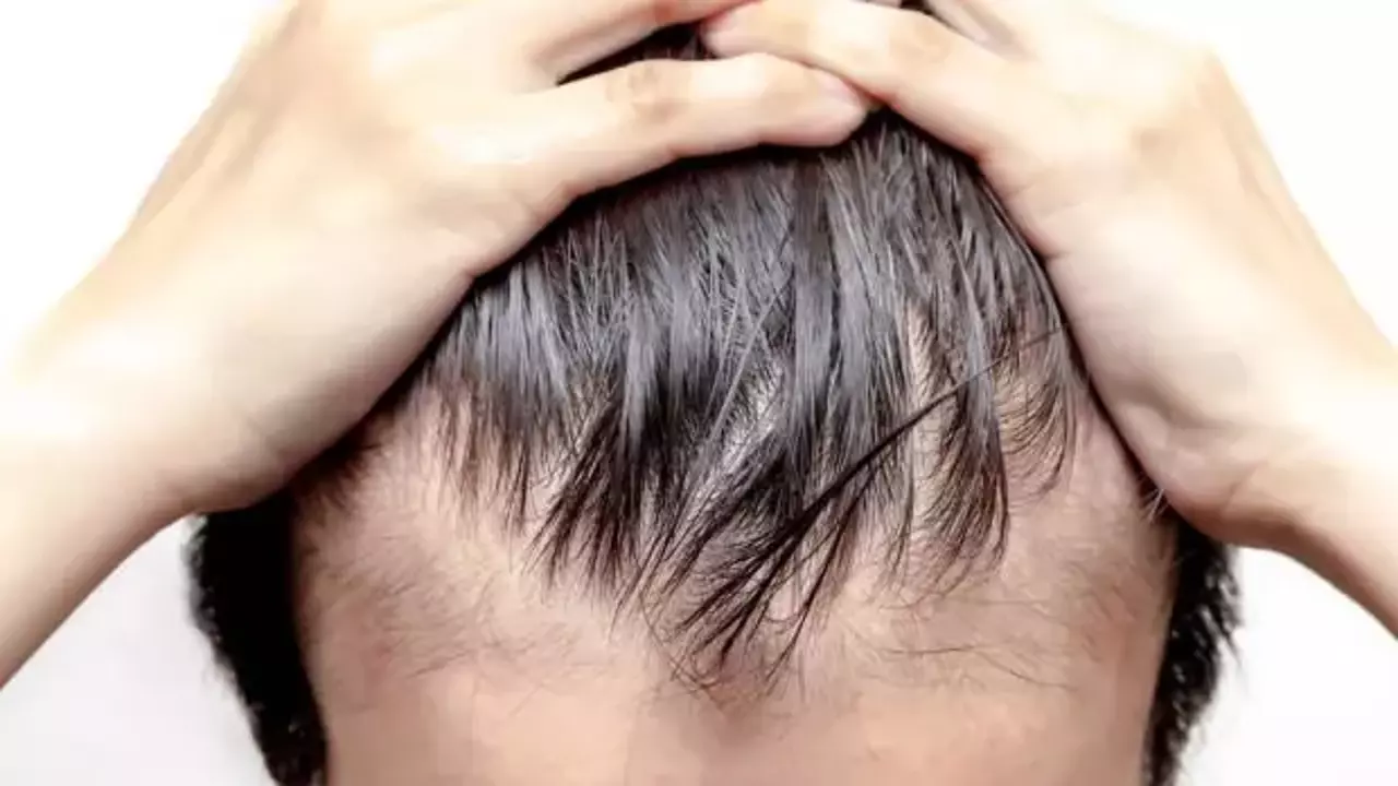 Erken Dökülen Saçlara 5 Doğal Çözüm! Bunları Kullanın Saç Dökülmesi Azalsın
